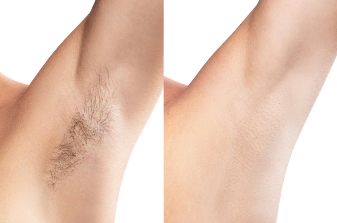 Visible Hair Reduction in 4 Weeks